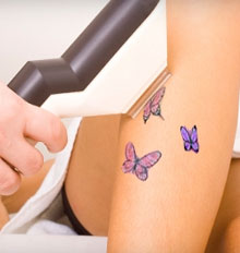 Alternative Tattoo Removal Alternative Tattoo Removal