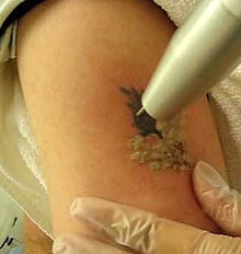 Blink Tattoo Removal Blink Tattoo Removal