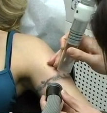 Cost of Tattoo Removal Cost of Tattoo Removal