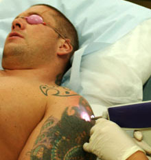 Dermaeraze Tattoo Removal Dermaeraze Tattoo Removal