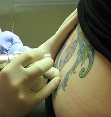 Free Tattoo Removal Options Free Tattoo Removal Options