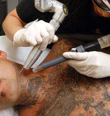 Gang Tattoo Removal Gang Tattoo Removal