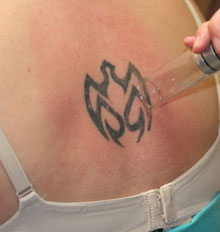Is Tattoo Removal Safe Is Tattoo Removal Safe