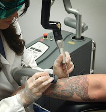 Laser Tattoo Removal Laser Tattoo Removal