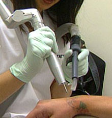Laserase Tattoo Removal Laserase Tattoo Removal
