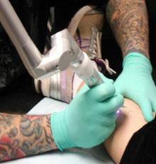 Naturalaser Tattoo Removal Naturalaser Tattoo Removal