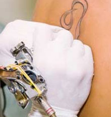 NHS Tattoo Removal NHS Tattoo Removal