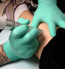 Rejuvi Tattoo Removal Rejuvi Tattoo Removal