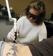 Side Effects of Tattoo Removal Side Effects of Tattoo Removal