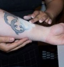 Tat B Gone Tattoo Removal Tat B Gone Tattoo Removal