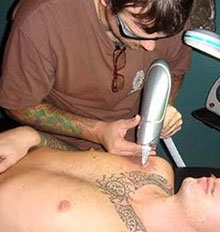 Tattoo Removal Companies Tattoo Removal Companies