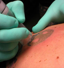 Tattoo Removal Cream vs Laser - Tattoo Removal Techniques ...