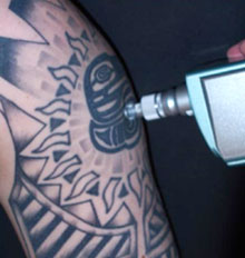 Tattoo Removal Dermabrasion Tattoo Removal Dermabrasion