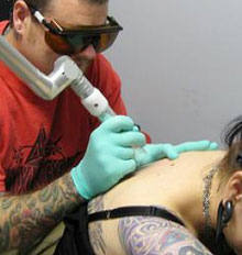 Tattoo Removal FAQs