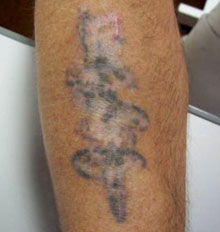 Tattoo Removal Post Treatment Facts Tattoo Removal Post Treatment Facts