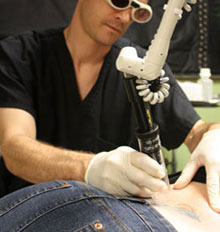 Tattoo Removal Process Tattoo Removal Process