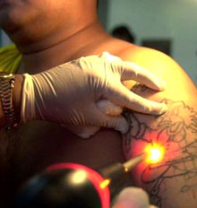 Tattoo Removal Replacements Tattoo Removal Replacements