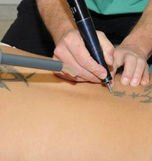 Tattoo Removal Specialists Tattoo Removal Specialists
