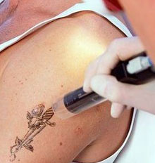 The Body Clinic Tattoo Removal The Body Clinic Tattoo Removal