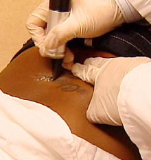 What Tattoo Removal is the Quickest What Tattoo Removal is the Quickest